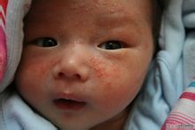 Eczema Baby