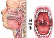 Ipertrofia tonsillare