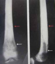 Sclerosante osteomielite