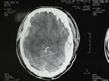 Ematoma intracranico