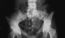 Osteolisi