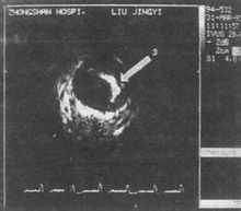 Angina Variant