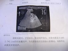 Gestazionale sac Echo