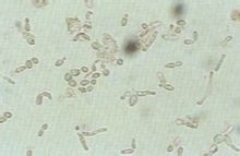 Splenomegalia