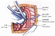 Resezione del cancro esofageo
