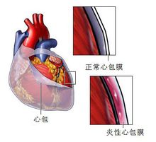 Tamponamento cardiaco
