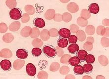 Leucemia a cellule Mast