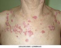 lupus cutaneo subacuto