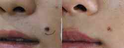 Mole Laser andare