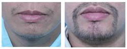 Beard trapianto