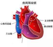 Malattia cardiaca congenita