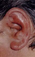 Pericondrite Ear