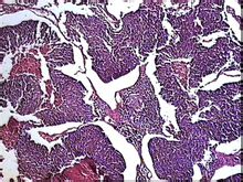 Carcinoma a cellule Avena