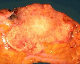 Carcinoma duttale invasivo